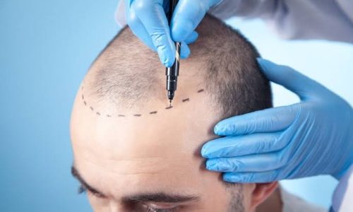 Hair Transplant-3